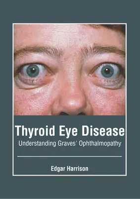 La maladie oculaire de la thyroïde : Comprendre l'ophtalmopathie de Graves - Thyroid Eye Disease: Understanding Graves' Ophthalmopathy