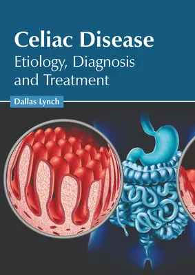 La maladie cœliaque : Étiologie, diagnostic et traitement - Celiac Disease: Etiology, Diagnosis and Treatment