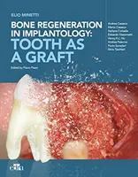 Régénération osseuse en implantologie - la dent comme greffon - Bone regeneration in implantology - tooth as a graft