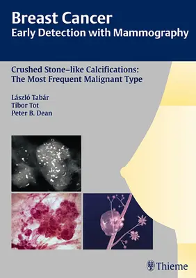 Le cancer du sein : Détection précoce par mammographie : Les calcifications en forme de pierre écrasée : Le type malin le plus fréquent [Avec CDROM] - Breast Cancer: Early Detection with Mammography: Crushed Stone-Like Calcifications: The Most Frequent Malignant Type [With CDROM]