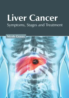 Le cancer du foie : Symptômes, stades et traitement - Liver Cancer: Symptoms, Stages and Treatment