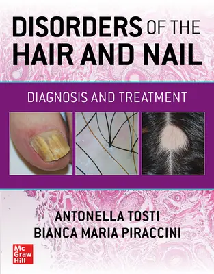 Troubles des cheveux et des ongles : Diagnostic et traitement - Disorders of the Hair and Nail: Diagnosis and Treatment