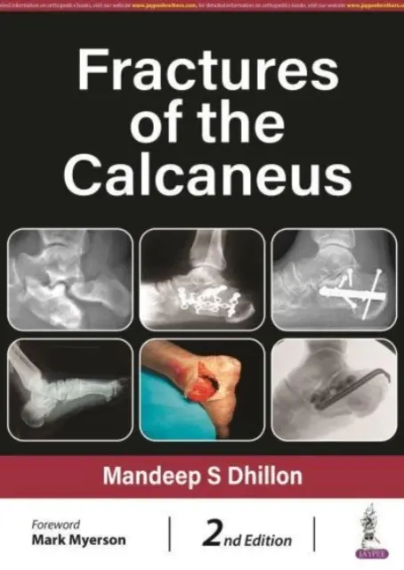 Fractures du calcanéum - Fractures of the Calcaneus