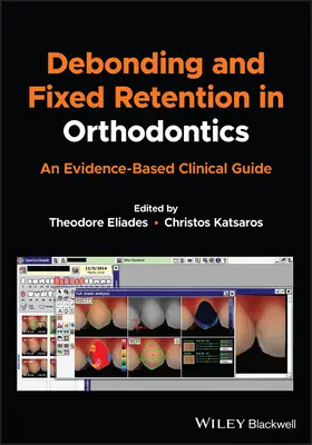 Le décollement et la rétention fixe en orthodontie : Un guide clinique fondé sur des données probantes - Debonding and Fixed Retention in Orthodontics: An Evidence-Based Clinical Guide